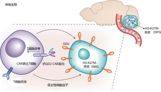 CAR-T细胞治疗儿童弥漫性中线胶质瘤