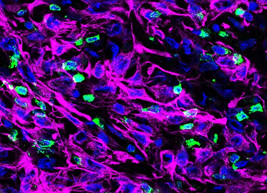 胰腺癌细胞是如何逃避T细胞追杀的